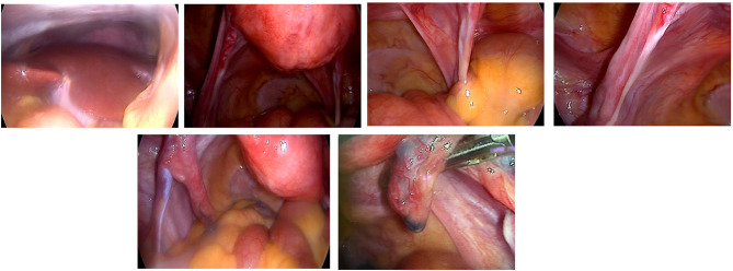 Bilateral Streak Ovaries in a Patient with Isochromosome Xq: A Case Report of a Turner Syndrome Variant.