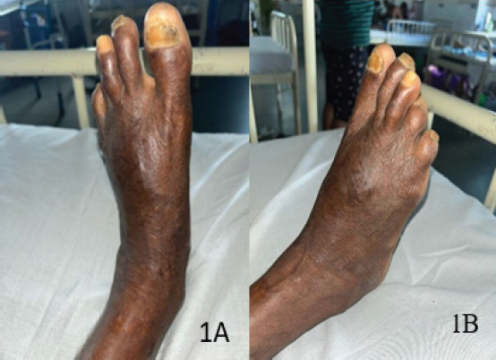 An Unusual Presentation of Keratinous Cyst - A Case Report.