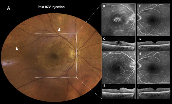 Unilateral uveitis following adjuvanted Varicella-Zoster subunit vaccine in a patient with previously resolved Varicella Zoster acute retinal necrosis.
