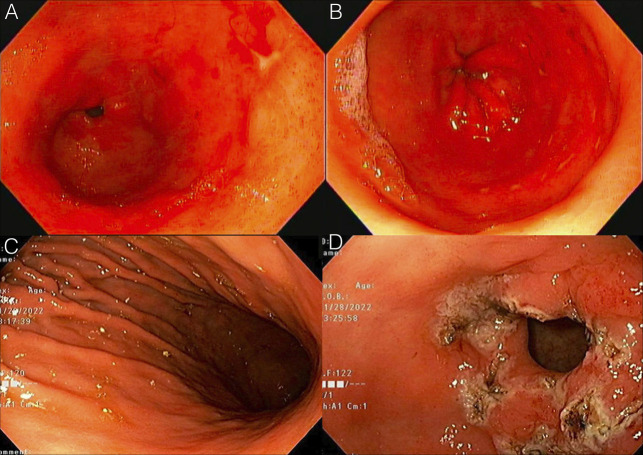 Hemorrhagic Gastropathy From Paclitaxel-Carboplatin Combination Chemotherapy.