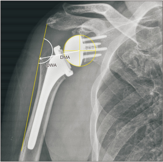 The Impact of Critical Shoulder Angle during Reverse Total Shoulder Arthroplasty: Is It Helpful?