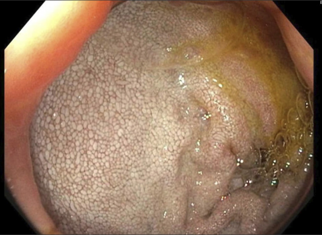 An Extremely Rare Cause of Protein-Losing Enteropathy: Waldenström Macroglobulinemia.