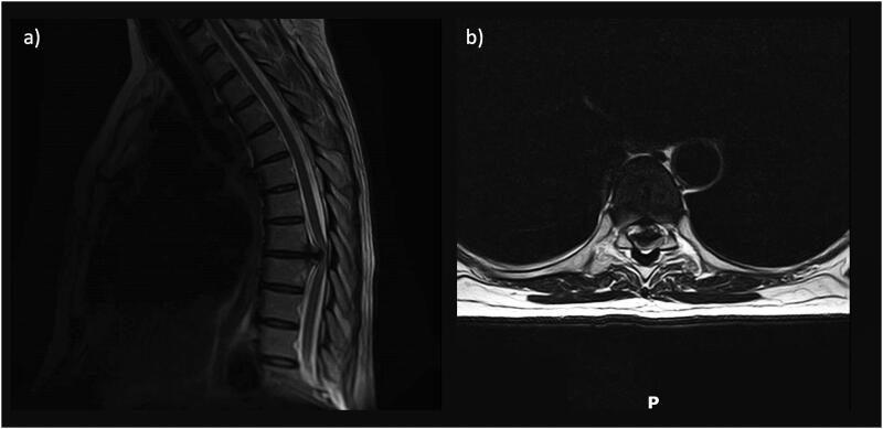 Patient-specific automated cerebrospinal fluid pressure control to augment spinal wound closure: a case series using the LiquoGuard®.