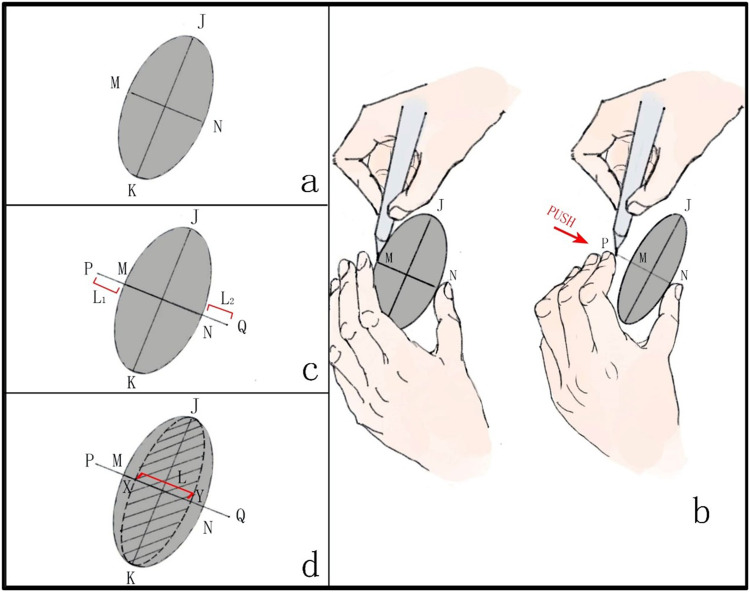 Geometric-Marking Quantification for First-Stage Excision of Large Congenital Melanocytic Nevi.