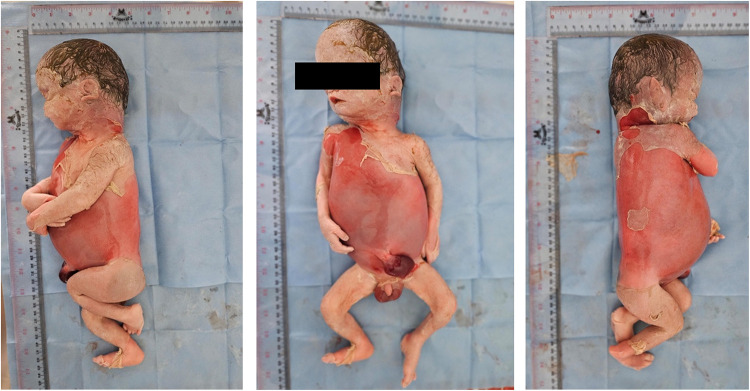 Non-Immune Hydrops Fetalis in a Pregnant Woman with Chronic Alcohol Use: A Case Report.