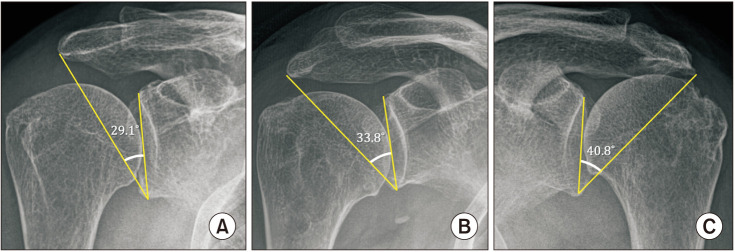 The Impact of Critical Shoulder Angle during Reverse Total Shoulder Arthroplasty: Is It Helpful?