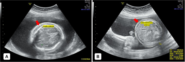 Non-Immune Hydrops Fetalis in a Pregnant Woman with Chronic Alcohol Use: A Case Report.