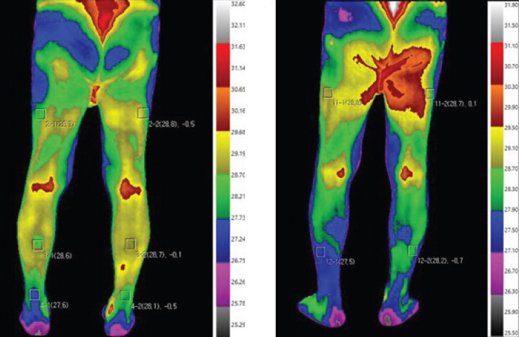 Thermographic Insights into Degenerative Spinal Disorders: Evaluating the Diagnostic Potential of Digital Infrared Thermography Imaging.
