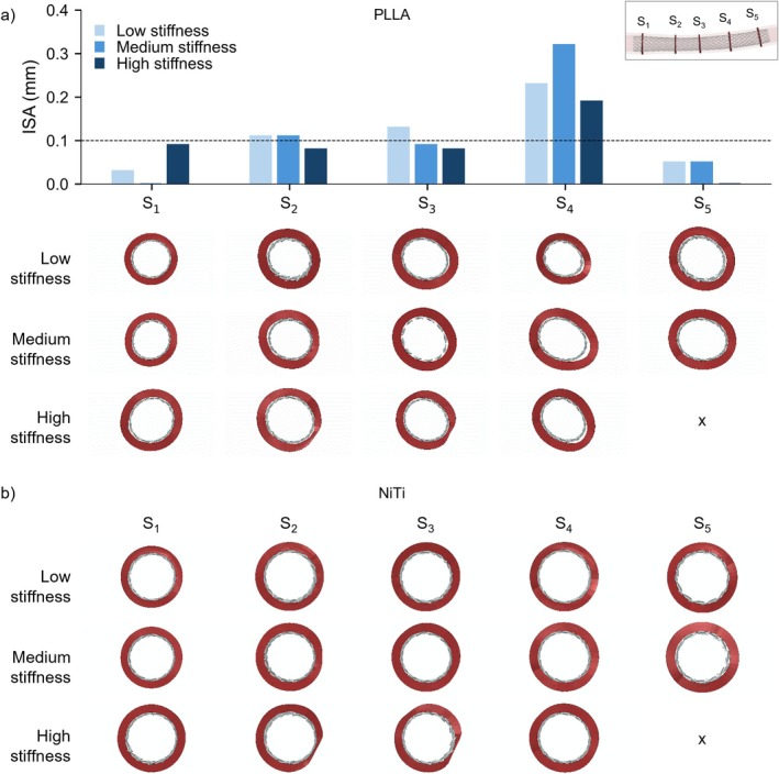 From Bench Testing to Virtual Implantation: A Comparative Study Between Poly-l-Lactic Acid and Nickel-Titanium Braided Stents.