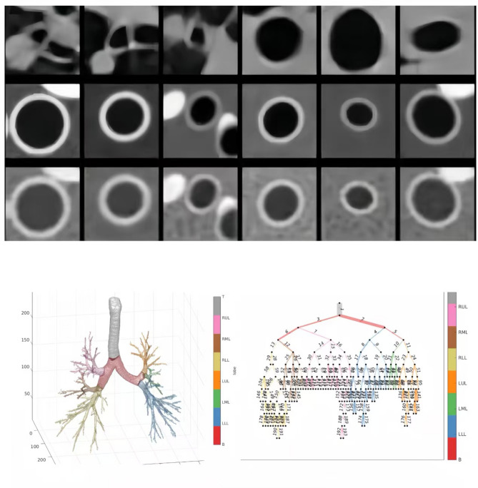 Utility of an artificial intelligence-based lung CT airway model in the quantitative evaluation of large and small airway lesions in patients with chronic obstructive pulmonary disease.
