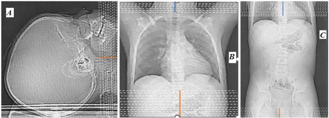 Determination of redundant scan coverages along the Z-axis and dose implications for common paediatric computed tomography imaging examinations in a limited resource setting.