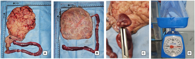 Non-Immune Hydrops Fetalis in a Pregnant Woman with Chronic Alcohol Use: A Case Report.