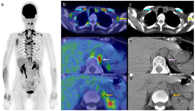 Effect of β3-adrenergic receptor agonists on [<sup>18</sup>F] fluorodeoxyglucose uptake in brown adipose tissues in positron emission tomography images of elderly patients.