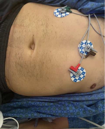 Recurrent Tachycardia, Abdominal, and Chest Pain as a Presentation of Stiff Person Syndrome.