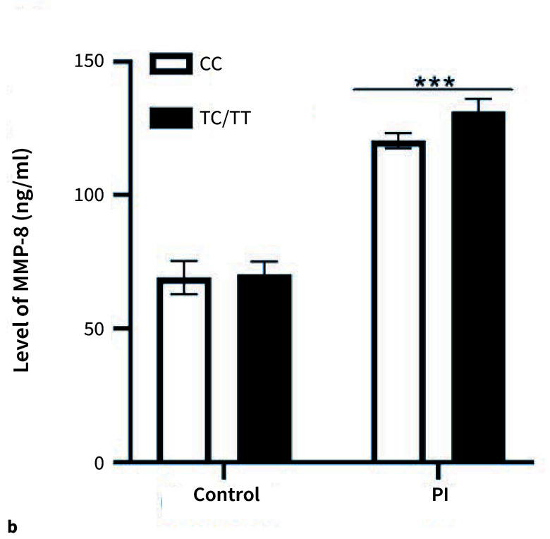 Association of MMP-8 rs11225395 Polymorphism with the Susceptibility of Peri-Implantitis.