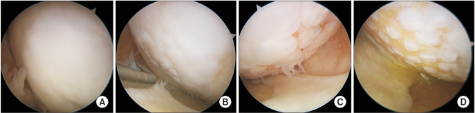 Clinical Benefits of Cartilage Repair in High Tibial Osteotomy Can Only Be Expected in Patients with Successfully Regenerated Cartilage.