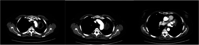 Successful Allogeneic Stem Cell Transplant for Philadelphia Chromosome Negative Acute Lymphoblastic Leukemia After Pneumonectomy for Pulmonary Mucormycosis: A Case Report and Review of the Literature.