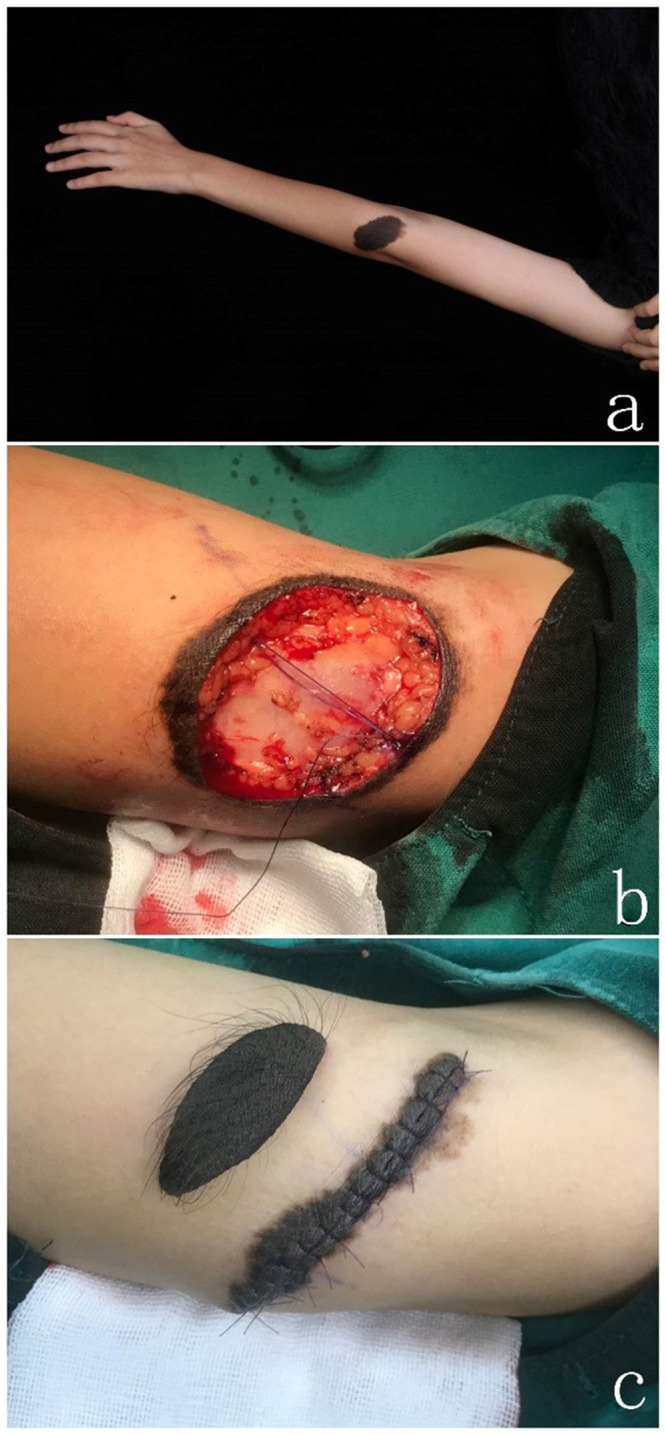 Geometric-Marking Quantification for First-Stage Excision of Large Congenital Melanocytic Nevi.