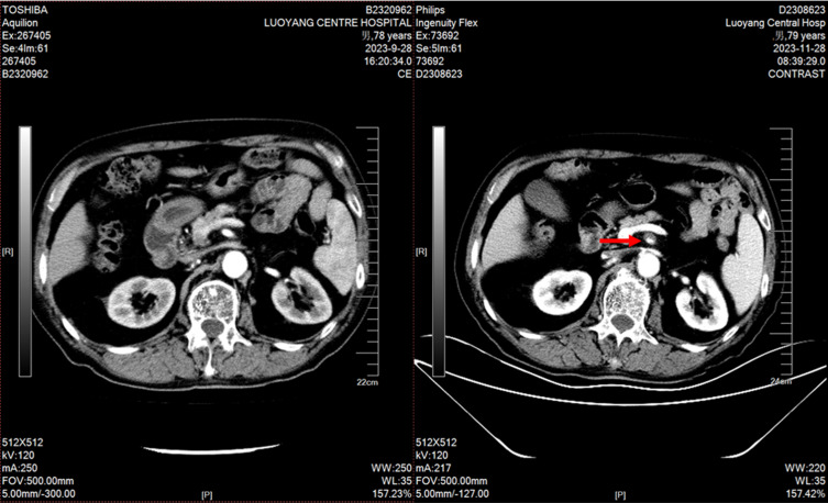 Mesenteric Artery Dissection Aneurysm Associated with Apatinib in a Prostate Cancer Patient: A Case Report and Literature Review.