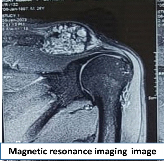 A Case Report of a Rare Entity - Lateral End of Clavicle Chondromyxoid Fibroma which was Mistaken as Giant Cell Tumor and Aneurysmal Cyst.