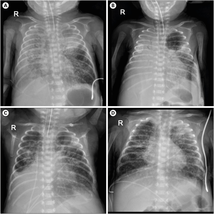 Successful Intraluminal Administration of Tissue Plasminogen Activator for Life-Threatening Obstructive Hematoma in Extremely Preterm Infants.