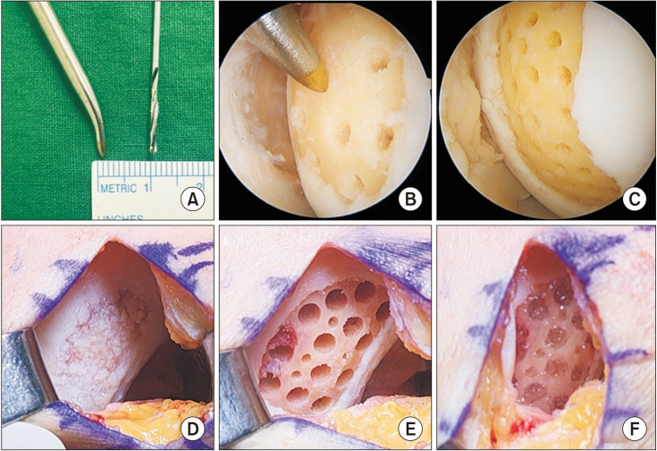 Clinical Benefits of Cartilage Repair in High Tibial Osteotomy Can Only Be Expected in Patients with Successfully Regenerated Cartilage.