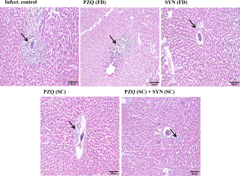 Optimizing the therapeutic benefits of synriam combined with praziquantel in mice harbouring juvenile and mature Schistosoma mansoni.