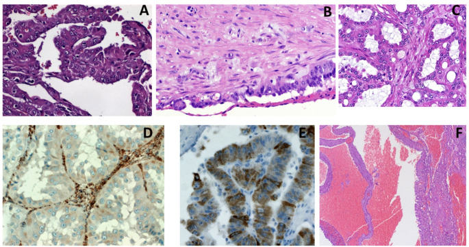 Targeting metabolic and epigenetic reprogramming in metastatic fumarate hydratase-deficient renal cell carcinoma.