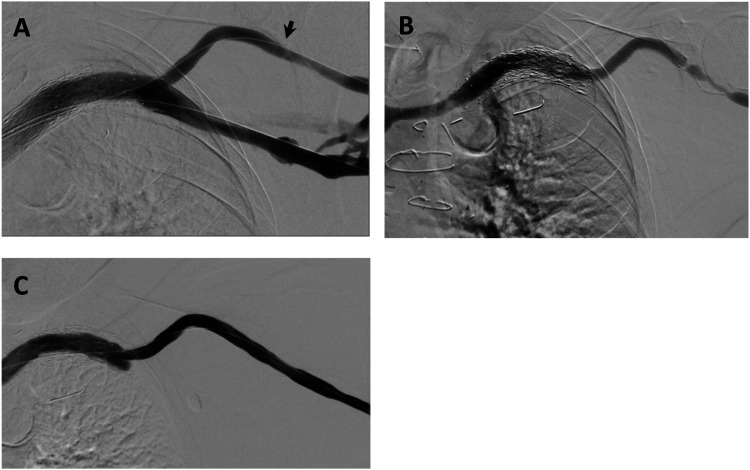 Patency rates following treatment with the WRAPSODY™ Cell-Impermeable Endoprosthesis for recalcitrant renal access circuit dysfunction: Results from a tertiary Australian centre.