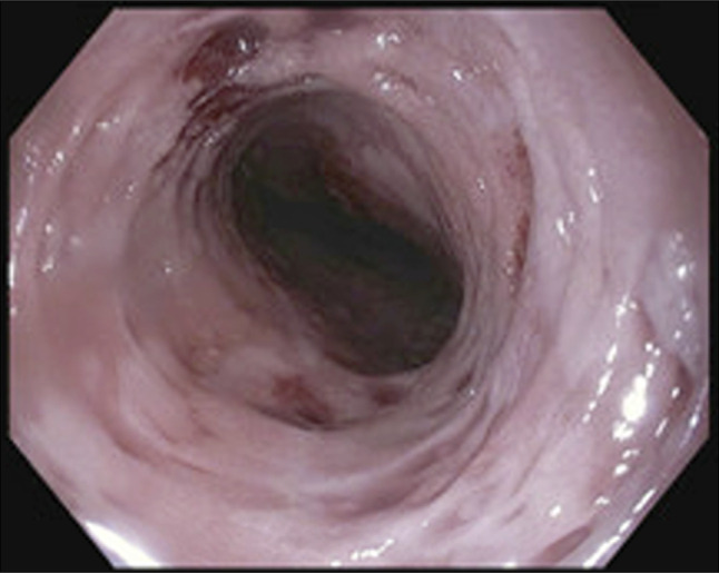 Multifocal Superficial Squamous Cell Carcinoma Arising in the Setting of Esophageal Intramural Pseudodiverticulosis.