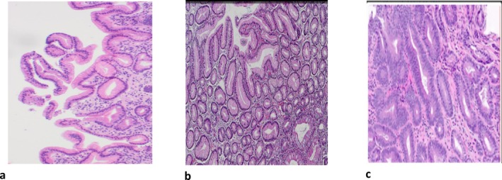 Conventional Upper-Intestinal Endoscopy Value in Predicting Histopathological Features Related to <i>Helicobacter pylori</i> Infection: A Comparative Study Between Endoscopy and Histology Findings Among Dyspeptic Outpatients in Cameroon.