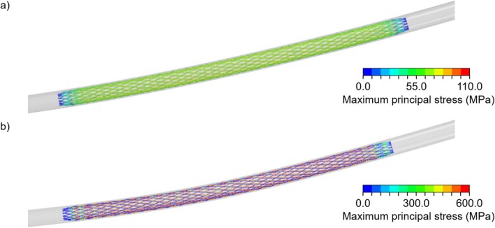 From Bench Testing to Virtual Implantation: A Comparative Study Between Poly-l-Lactic Acid and Nickel-Titanium Braided Stents.