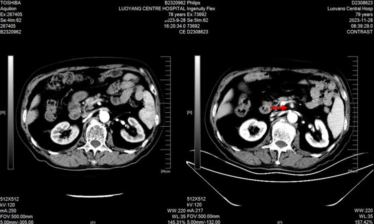 Mesenteric Artery Dissection Aneurysm Associated with Apatinib in a Prostate Cancer Patient: A Case Report and Literature Review.