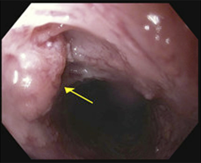 Multifocal Superficial Squamous Cell Carcinoma Arising in the Setting of Esophageal Intramural Pseudodiverticulosis.