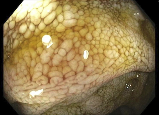An Extremely Rare Cause of Protein-Losing Enteropathy: Waldenström Macroglobulinemia.