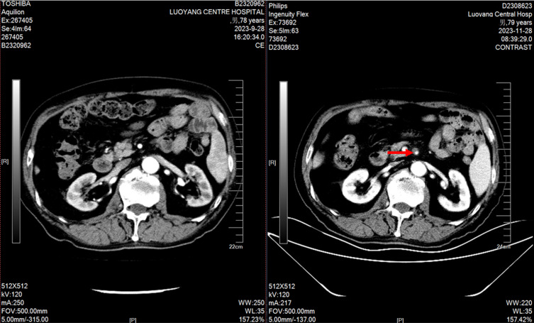 Mesenteric Artery Dissection Aneurysm Associated with Apatinib in a Prostate Cancer Patient: A Case Report and Literature Review.