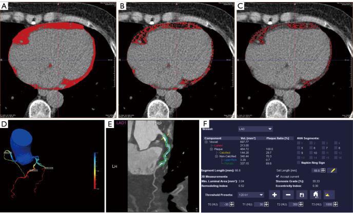 Influence of specific components of pericardial fat on coronary high-risk plaque prediction.