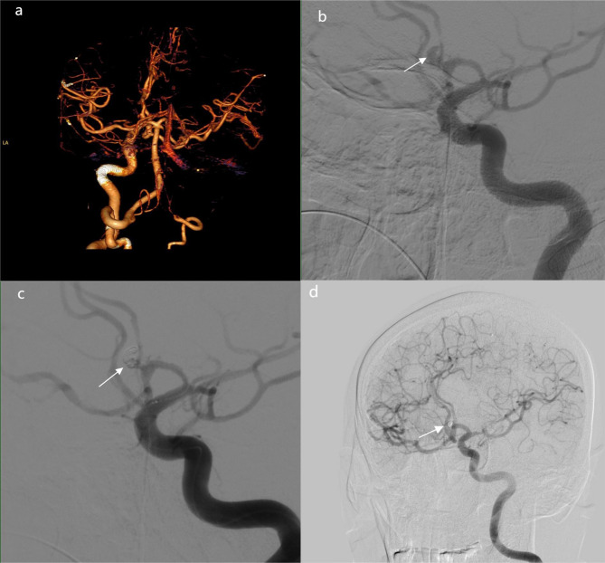 Ruptured intracranial aneurysm with spontaneous occlusion of internal carotid artery: clinical characteristics, prognostic risk factors, and survival analysis.