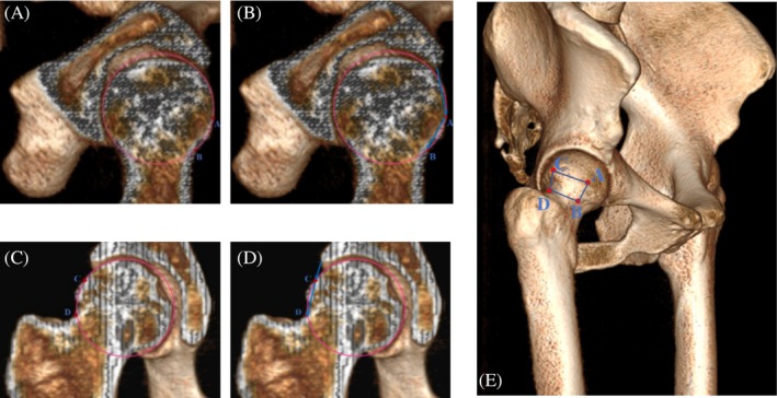 Quantitative Evaluation and Preoperative Planning Using Three-Dimensional CT Profiles Improves the Accuracy of Bony Correction Under Primary Hip Arthroscopy and Clinical Outcomes in the Setting of Cam-Type Femoroacetabular Impingement Syndrome.