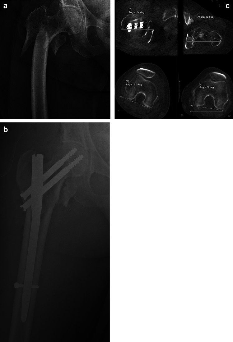 Femoral malrotation after trochanteric fracture nailing: what is the safety zone of limb rotation during closed reduction?
