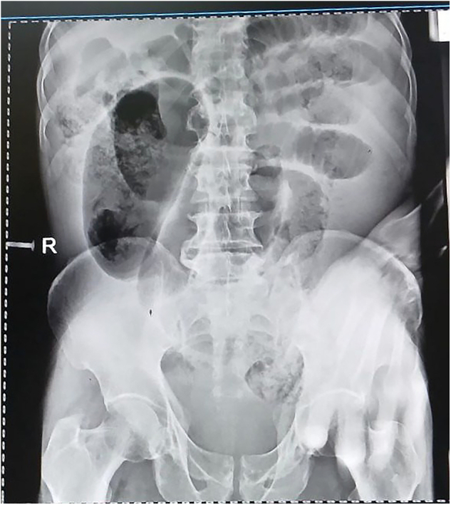 Ileosigmoid knotting: A rare cause of acute abdomen with fatal outcome in a 60-year-old man: Case report from a resource-limited setting.