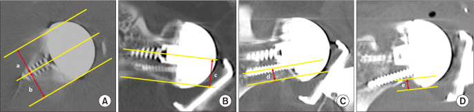 Clinical and Radiological Comparison between Asian-Type and Conventional Reverse Shoulder Arthroplasty: A Multicenter Randomized Controlled Trial.