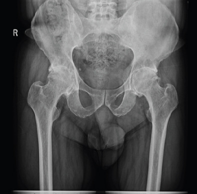 Unexplained Pseudotumor Formation in Ceramic-on-ceramic Hip Bearings: A Case Report.