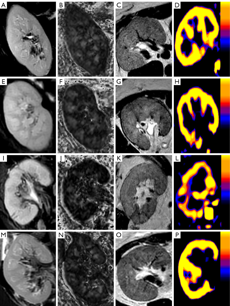 Prospective evaluation of arterial spin labeling and diffusion tensor imaging-magnetic resonance imaging for the non-invasive assessment of renal allograft dysfunction.