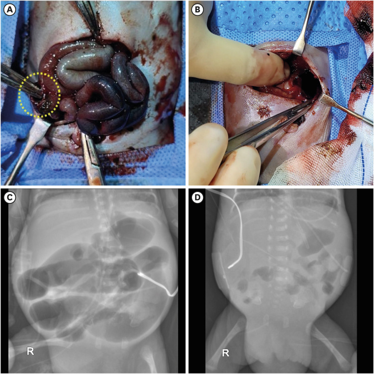 Successful Intraluminal Administration of Tissue Plasminogen Activator for Life-Threatening Obstructive Hematoma in Extremely Preterm Infants.