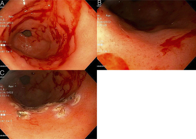 Hemorrhagic Gastropathy From Paclitaxel-Carboplatin Combination Chemotherapy.