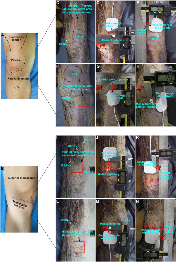 Electrode Placement Affects Clinical Outcome in Transcutaneous Electrical Nerve Stimulation for Knee Osteoarthritis: A Combined Cadaver Study and Randomized Controlled Trial.