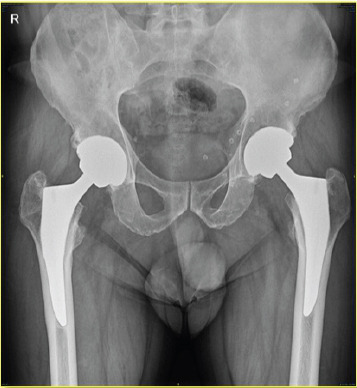 Unexplained Pseudotumor Formation in Ceramic-on-ceramic Hip Bearings: A Case Report.