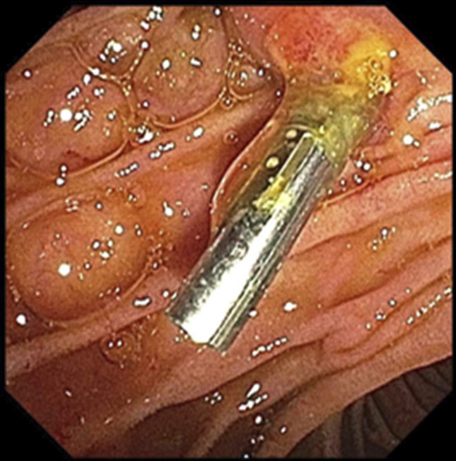 Navigating Complications: A Case of Hemostatic Clip-Induced Biliary Obstruction Leading to Acute Cholangitis.