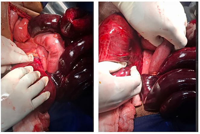 Ileosigmoid knotting: A rare cause of acute abdomen with fatal outcome in a 60-year-old man: Case report from a resource-limited setting.